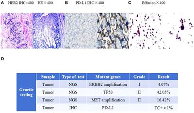 Combination treatment with anti-HER2 therapeutic antibody RC48, PD-1 inhibitor, radiotherapy, and granulocyte macrophage-colony stimulating factor (GM-CSF) in patient with metastatic gastric cancer: a case report